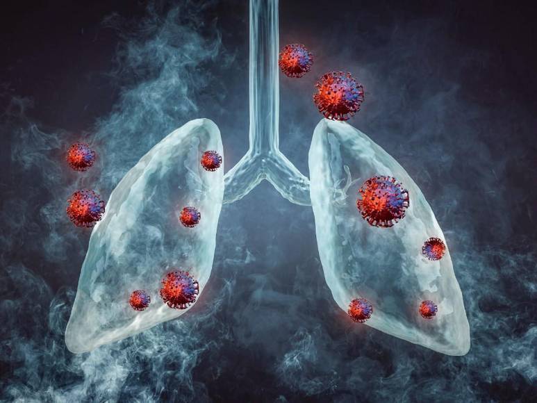 ¿Qué es bronquitis aguda, enfermedad diagnosticada a la presidenta Xiomara Castro?