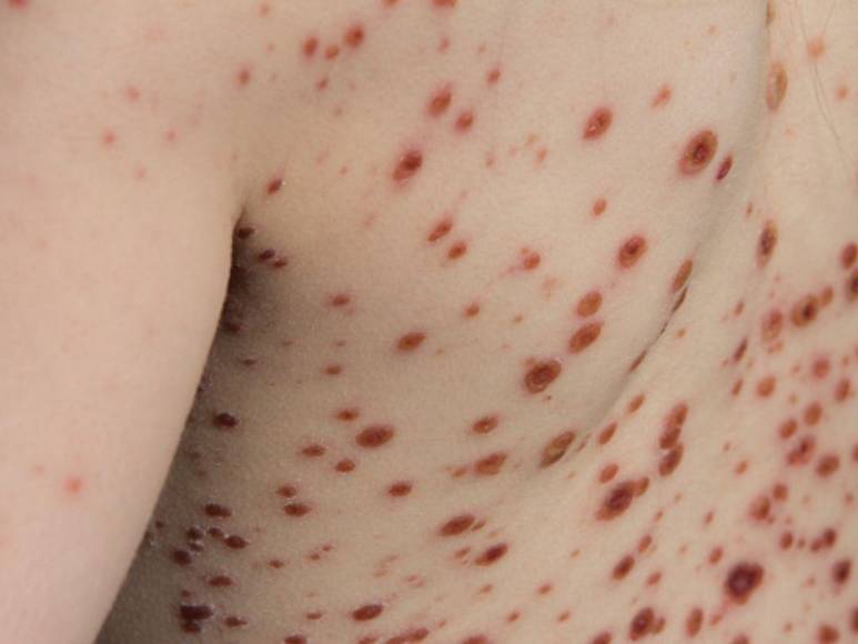 Viruela del mono ya está en Centroamérica, Costa Rica confirmó su primer caso sospechoso