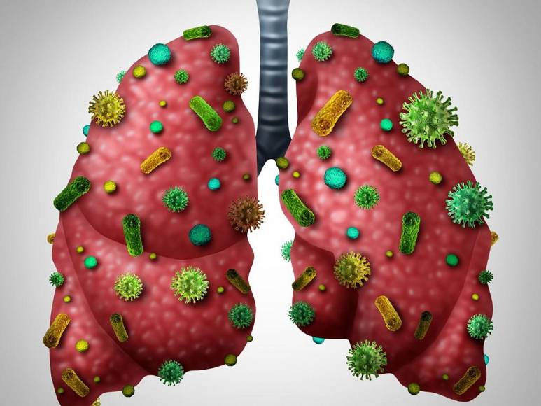 ¿Qué es bronquitis aguda, enfermedad diagnosticada a la presidenta Xiomara Castro?