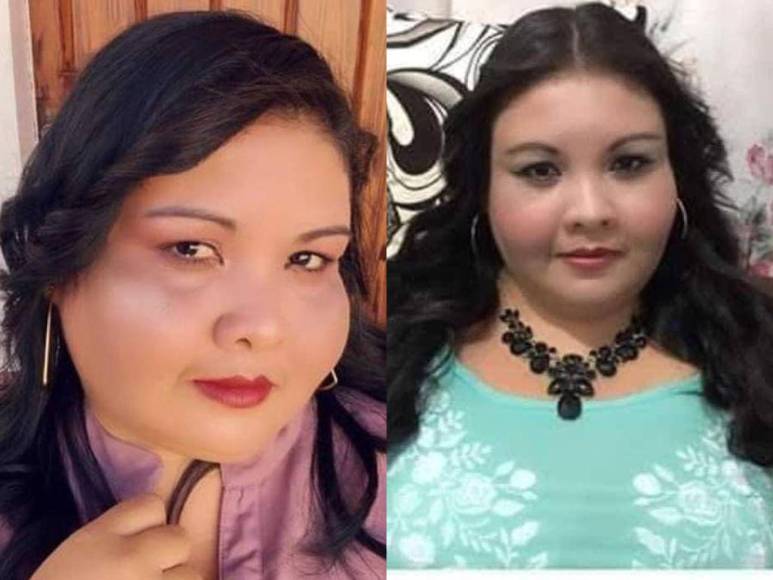 ¿Fue por extracción de muela? Revelan las causas de muerte de la hondureña Cristina Lagos en Hospital del Sur