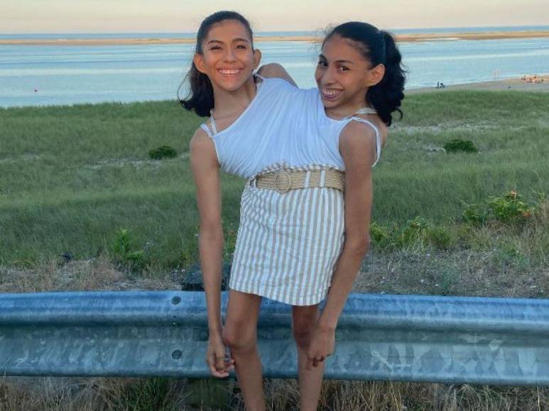 Una relación con estrictos acuerdos: así es el noviazgo de Daniel con Carmen, siamesa que comparte pelvis con su hermana