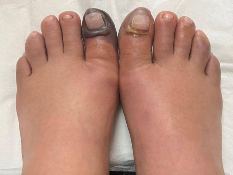 Dora Raudales se encuentra en recuperación luego de escalar el Monte Everest