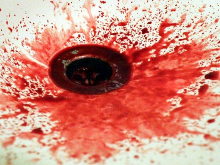 Qué es hemotórax, uno de los hallazgos en autopsia de Wilson Pérez, agresor de mujer policía