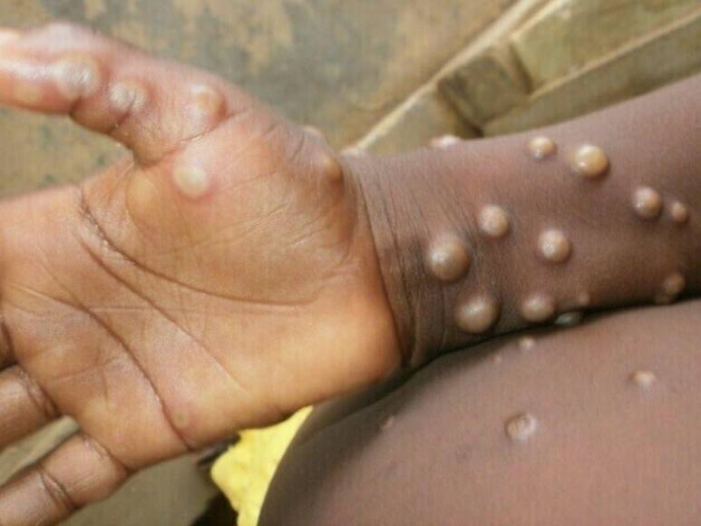 ¿Cómo se contagia la viruela del mono y cuáles son los síntomas para detectarla?