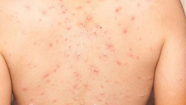 Mialgia y letargo: ¿Cuáles son los otros síntomas de la viruela del mono?