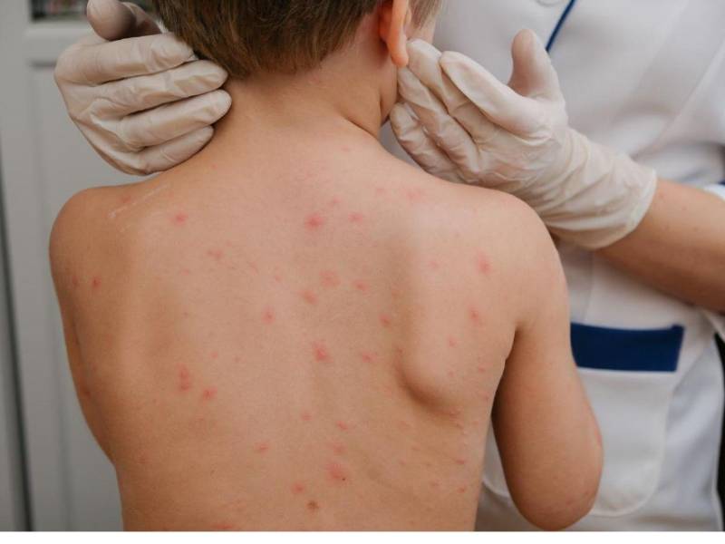 Autoridades sanitarias alertan que el 2025 cerró el año con el 65% de vacunación contra el sarampión. Piden a la población mantenerse alerta y aplicar las medidas necesarias para prevenir la enfermedad.