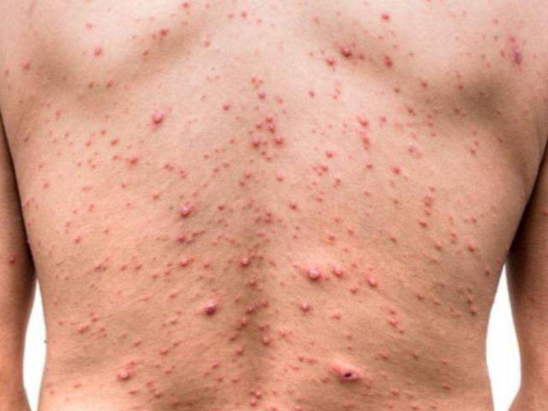 Epidemia de viruela del mono retrocede,  pero no desapareció