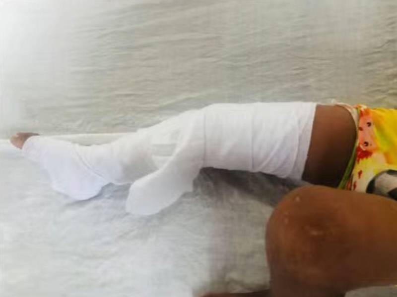 Así quedó el pie del menor tras ser golpeado por este conductor.