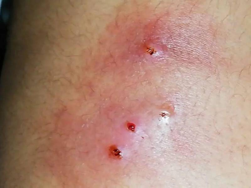 La mosca deja sus huevecillos en heridas expuestas, cuando se convierten en larvas se comen el tejido vivo de las personas.