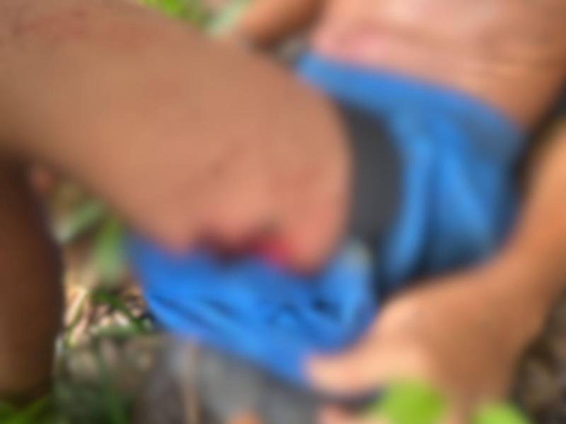 Mordedura que el perro de raza pitbull provocó en la pierna de uno de los dos menores.