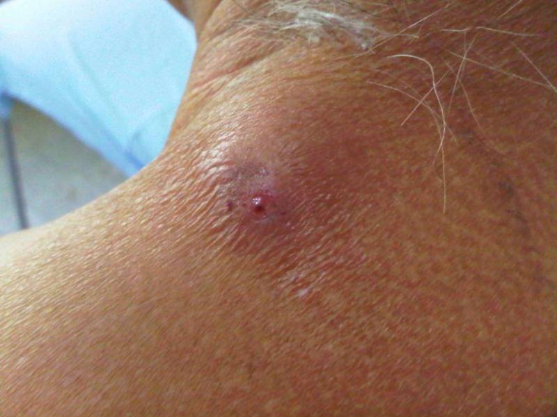 La mayoría de los pacientes afectados por miasis causada por le gusano barrenador son adultos mayores de 50 años con comorbilidades.