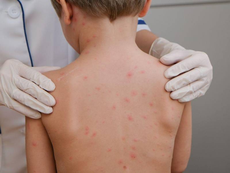 La Secretaría de Salud confirmó cuatro casos de sarampión en una familia de Cofradía, San Pedro Sula, y reforzó la vacunación para contener la propagación del virus.