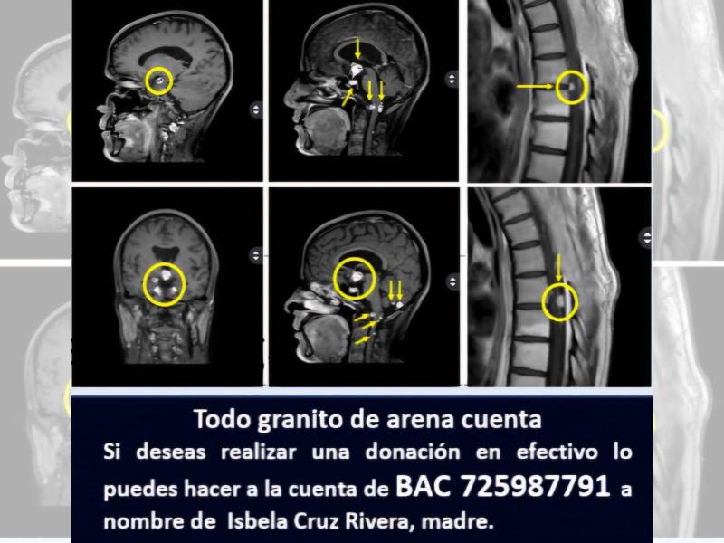 Familiares piden ayuda solidaria para costear el tratamiento Gamma Knife que podría frenar el avance de los tumores que amenazan funciones vitales.