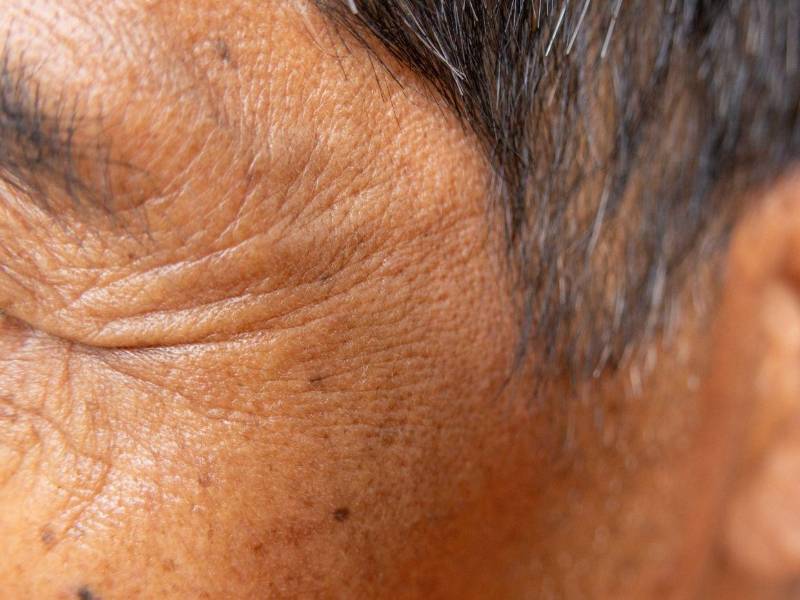 La piel masculina suele mostrar arrugas más tarde que la femenina, pero cuando aparecen tienden a ser más profundas y marcadas.