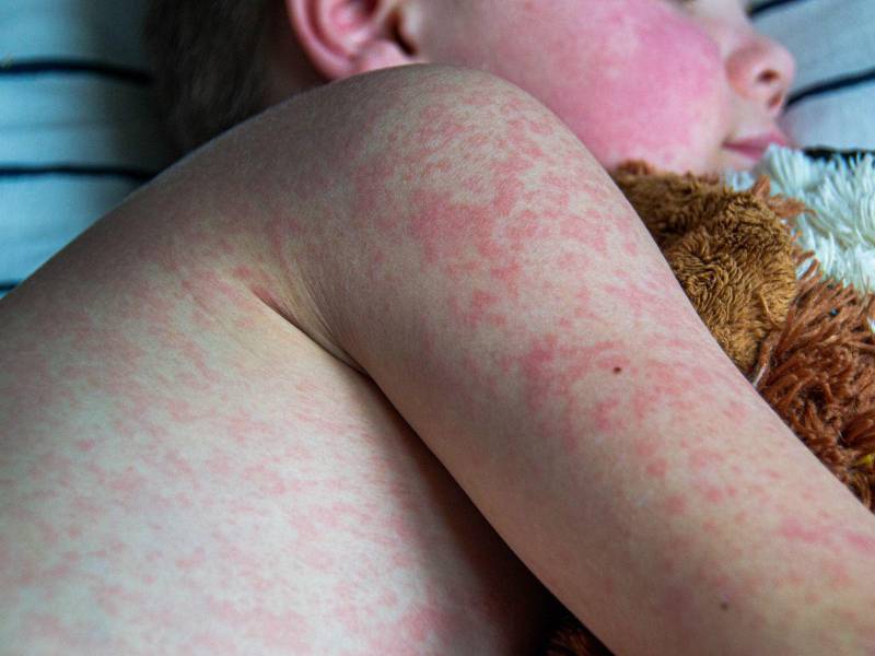 Salud intensifica controles por brotes cercanos y pide a la población completar esquemas de vacuna y acudir al centro asistencial si aparecen signos sospechosos.