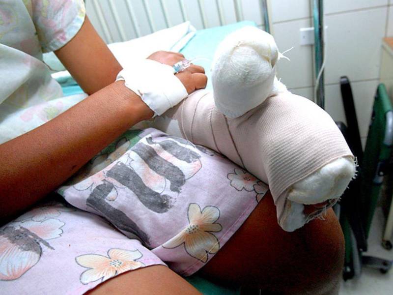 Según las autoridades de distintos centros médicos, el uso de la pólvora pesada fue un factor determinante para el ingreso e incluso amputación parcial en las manos de 5 menores de edad.