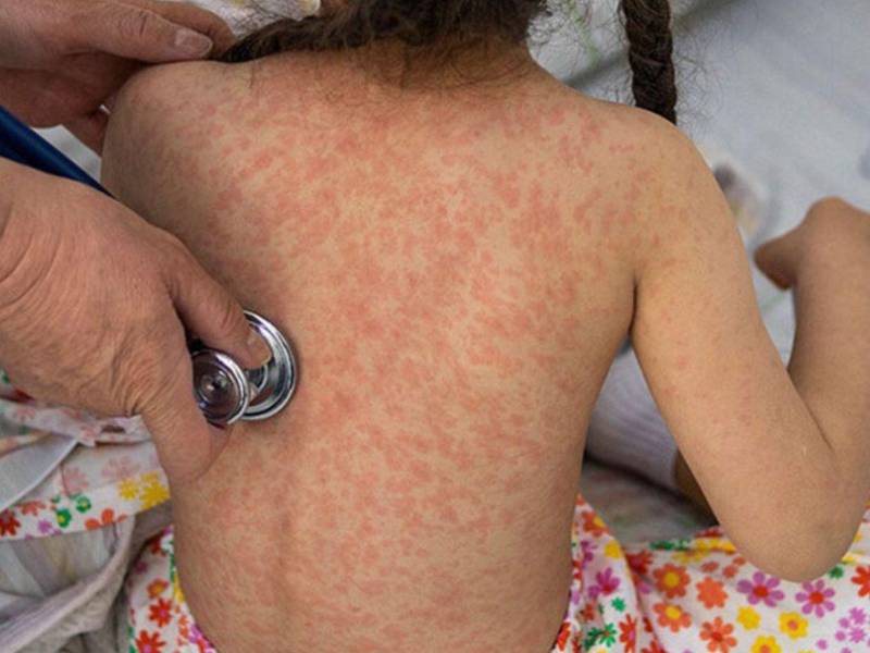 La Secretaría de Salud activó un cerco epidemiológico en Cortés tras confirmar el caso 13 de sarampión, correspondiente a un bebé de seis meses que se recupera en condición estable.