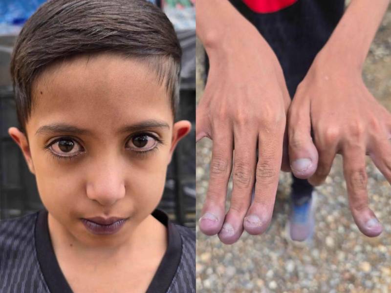 Josué Nehemías Cruz Cruz, un niño hondureño de 11 años, recibirá atención médica especializada en El Salvador luego de que su caso llegara hasta las autoridades de ese país tras una extraña condición. Aquí le explicamos su caso: