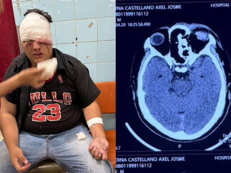 El estudiante sufrió lesiones durante el enfrentamiento con agentes policiales.