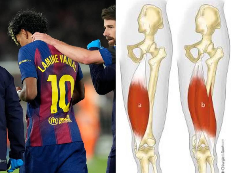 Toda España en alerta de cara al Mundial 2026, luego de que Lamine Yamal saliera lesionados a 50 días de la justa. Lo que se sabe de sus afectación.