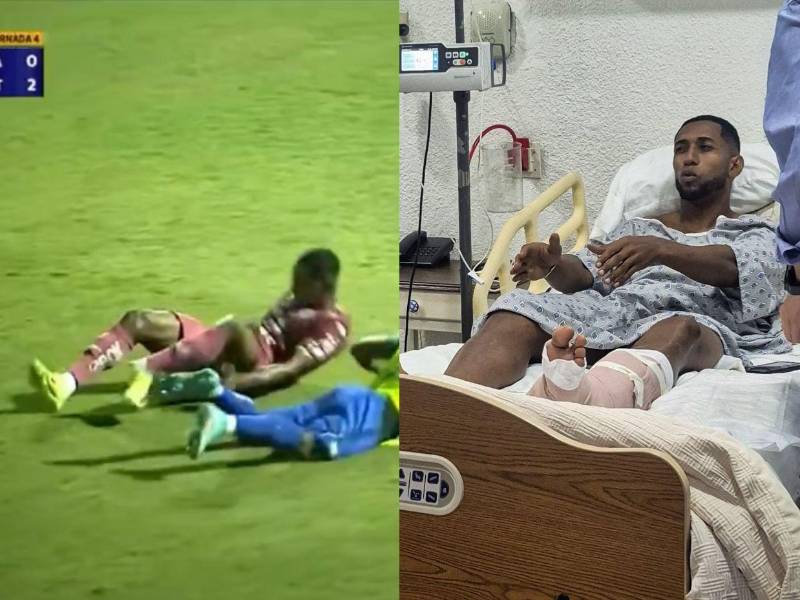 Romario da Silva, futbolista de Motagua, fue operado luego de la espantosa lesión que sufrió la noche del 12 de mayo ante Potros de Olancho. ¿Volverá a jugar profesionalmente? Esto es lo que se sabe.