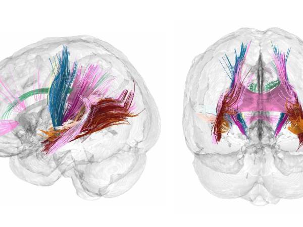 El escaneo cerebral de una embarazada mostró que algunas áreas se encogieron, lo que se revirtió hasta 2 años después. (Daniela Cossio)