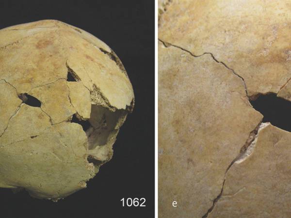 Fragmentos de cráneo, con evidencia de traumatismos contundente, recuperados de una fosa común en Inglaterra.
