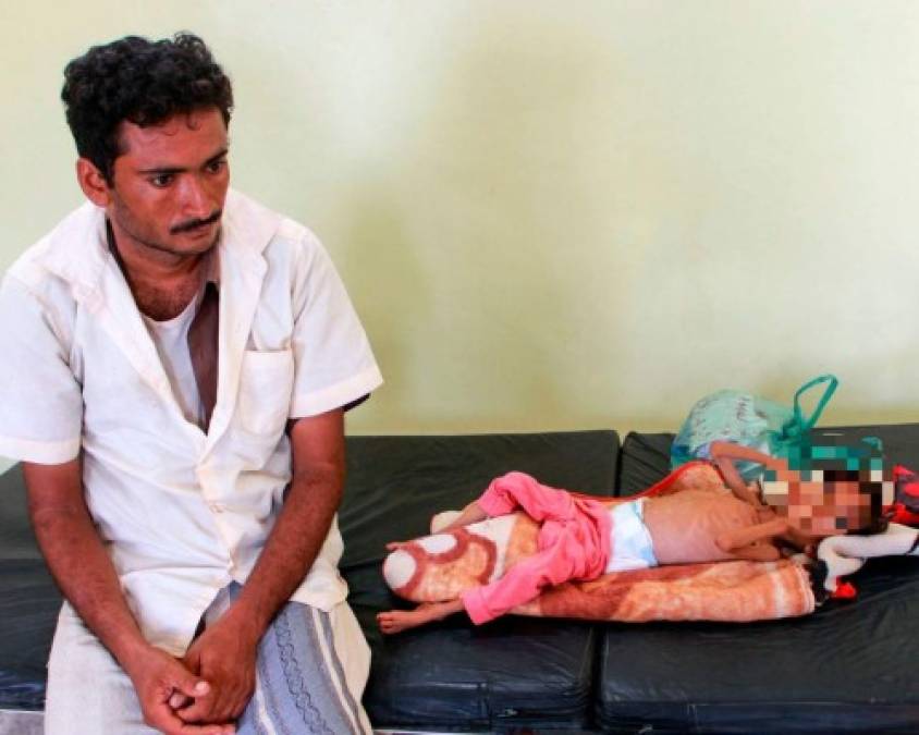 Impactantes y dolorosas imágenes de la desnutrición en Yemen