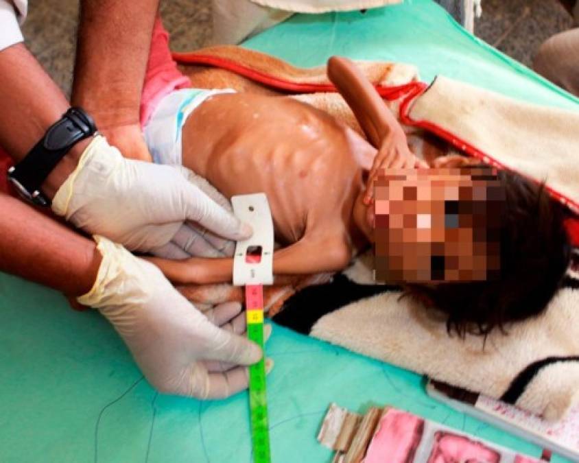 Impactantes y dolorosas imágenes de la desnutrición en Yemen