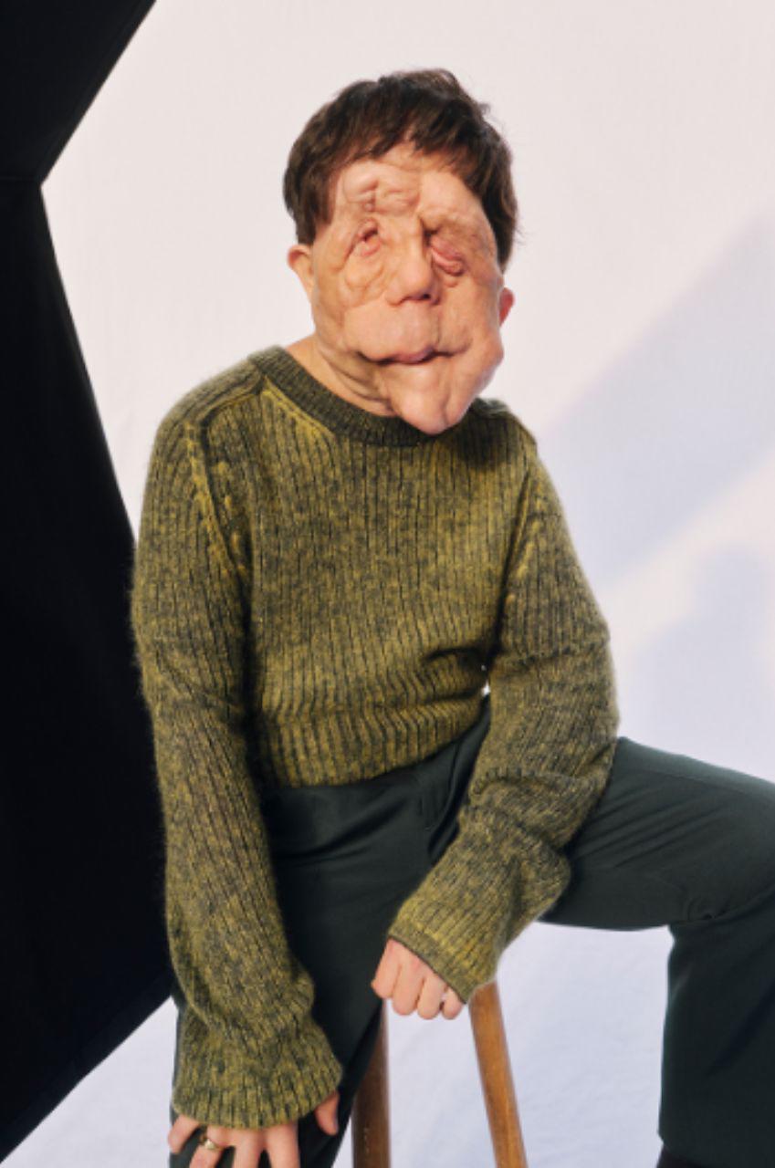 Adam Pearson, el actor con neurofibromatosis que brilló en los Oscar 2026