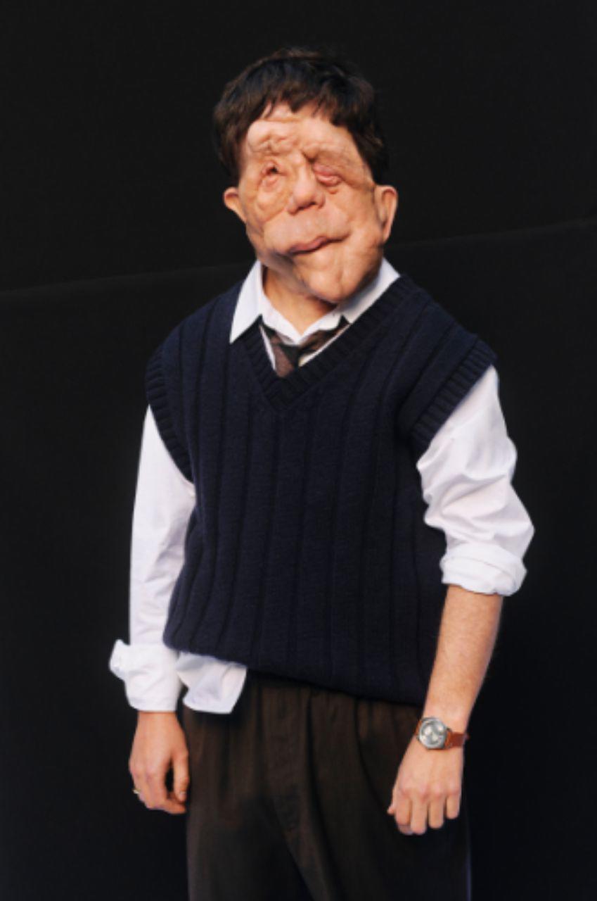 Adam Pearson, el actor con neurofibromatosis que brilló en los Oscar 2026