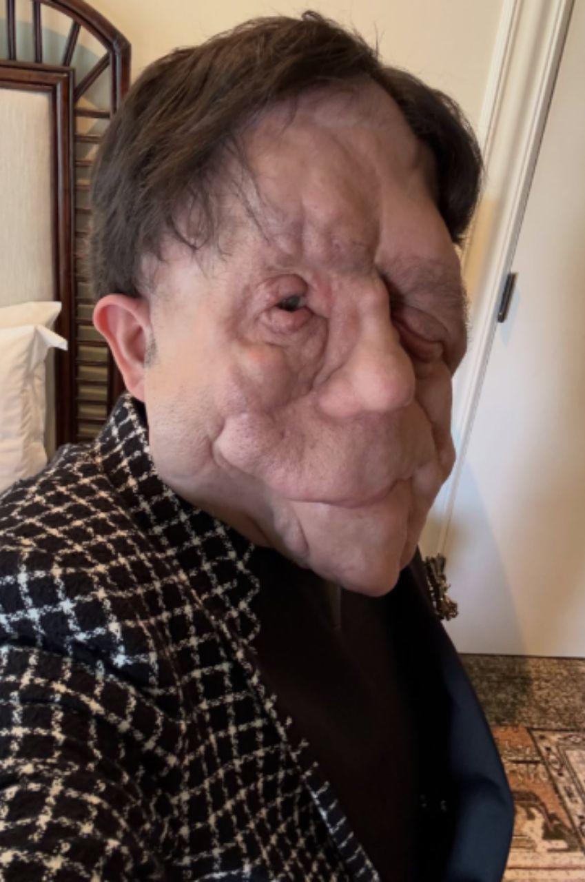Adam Pearson, el actor con neurofibromatosis que brilló en los Oscar 2026