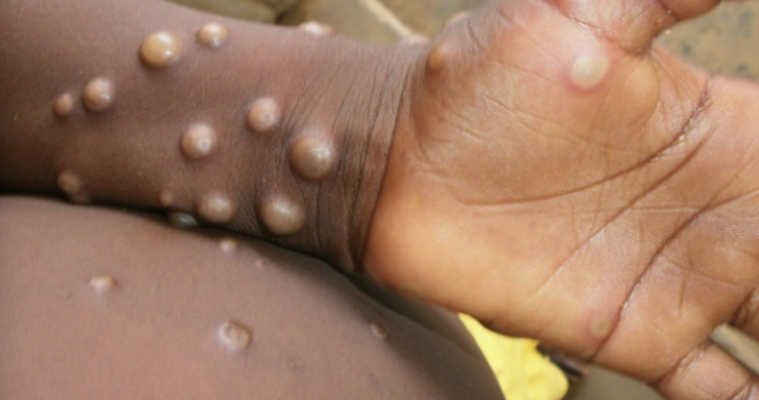 ¿Cómo se transmite la viruela del mono, la enfermedad que no tiene tratamiento?