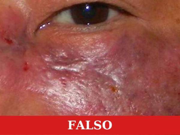 Honduras contabiliza al menos 40 casos de hongo negro en más de 13 meses desde el primer enfermo.