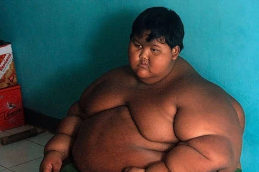 El impactante cambio físico de Arya Permana, el niño más gordo del mundo