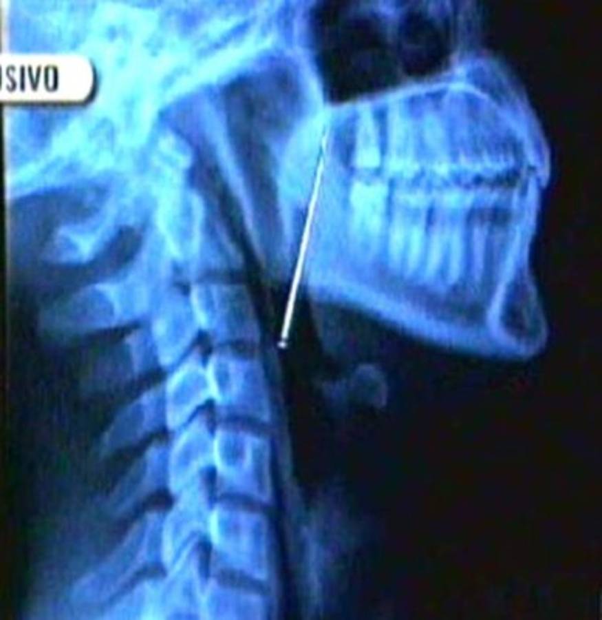 Niña en peligro al tragar alfiler