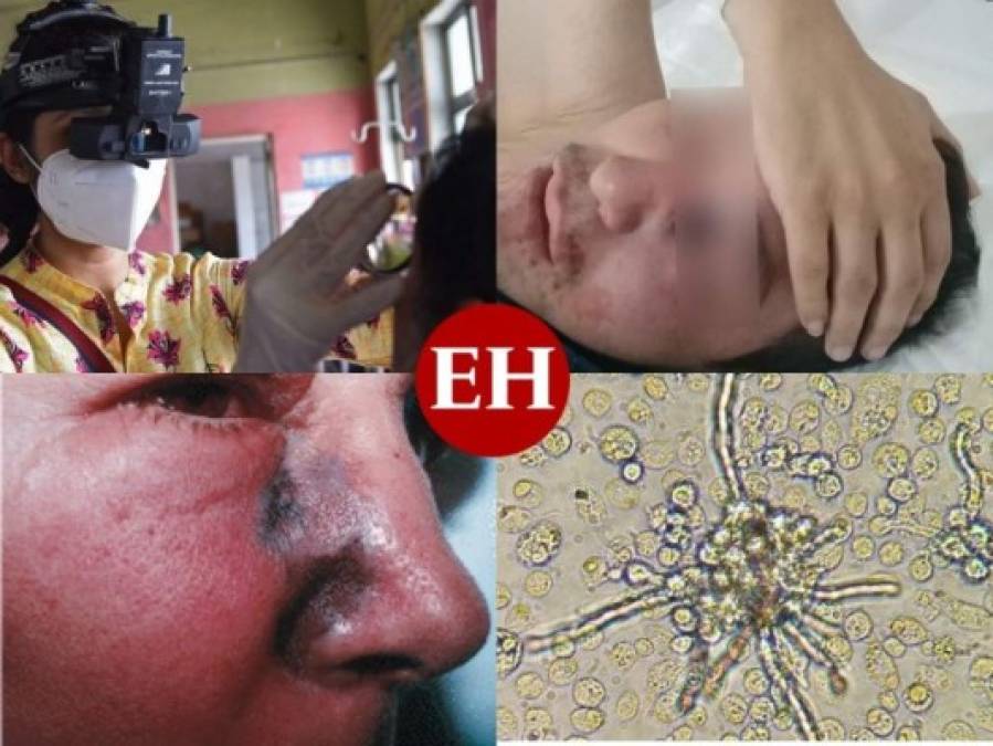 México: Extirpan ojo, parte de nariz y paladar a primer paciente con hongo negro