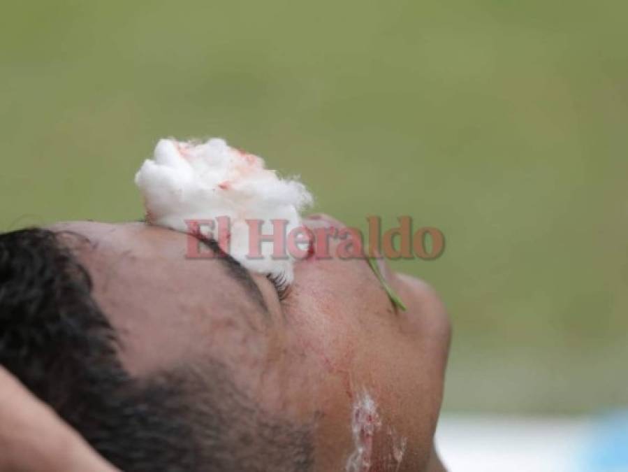 Samuel Córdova salió del partido Marathón vs Real España con la nariz rota