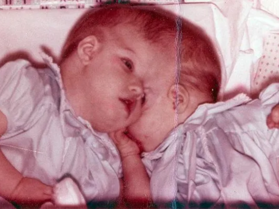 Mueren Lori y George Schappell, los gemelos siameses más longevos del mundo