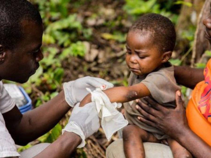 Alerta por casos de viruela del mono a nivel mundial: ¿Podría convertirse en pandemia?