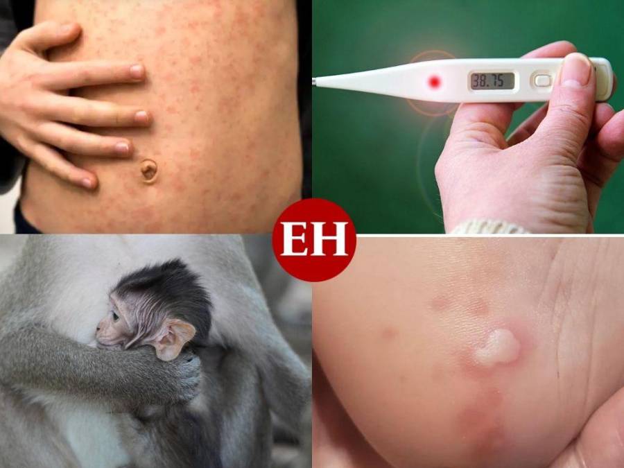 Lo que se sabe de la viruela del mono, enfermedad que alarma a Europa