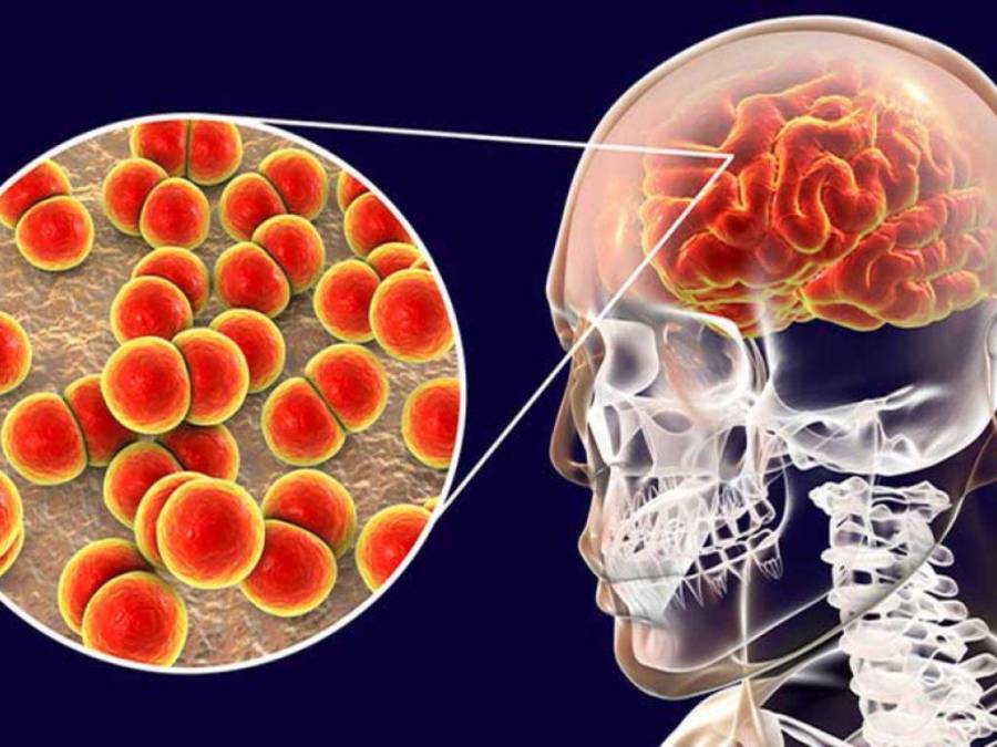 ¿Qué es la meningitis bacteriana? La verdadera causa de muerte de Cristina Lagos