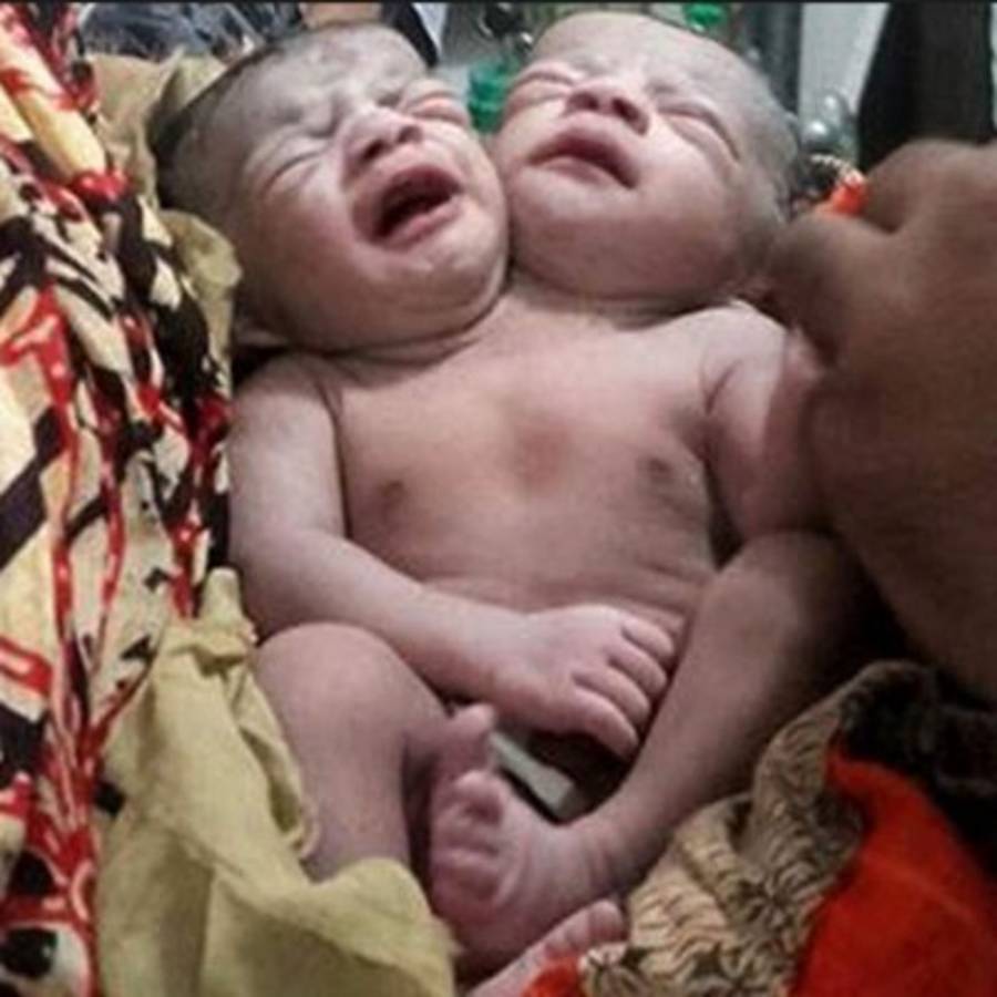 Nace una niña con dos cabezas en Bangladesh