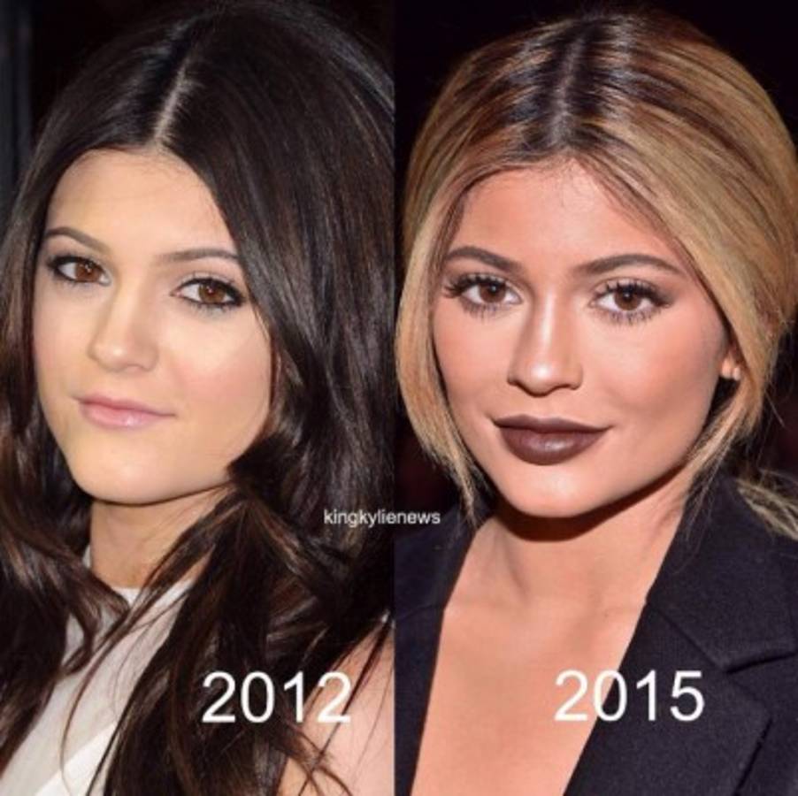 ¡Al descubierto! Cirujano plástico de Kylie Jenner destapa todas las cirugías que se realizó la modelo
