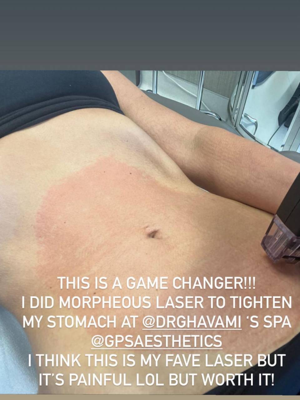 El doloroso tratamiento de Kim Kardashian para tonificar su abdomen