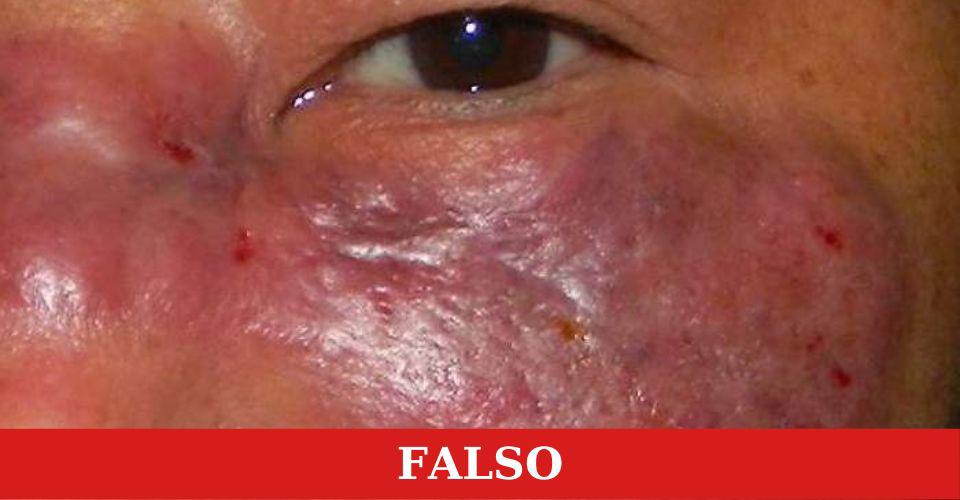 ¿El hongo negro se transmite entre personas?