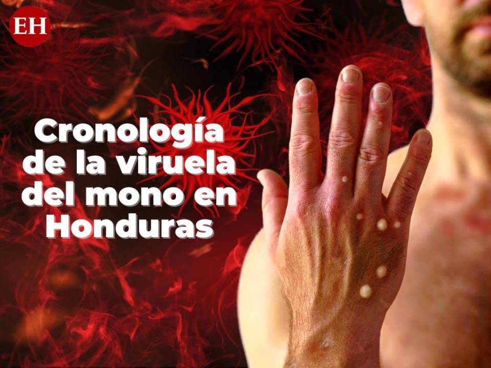 El 12 de agosto pasado se reportaba el primer caso de viruela del mono en Honduras.