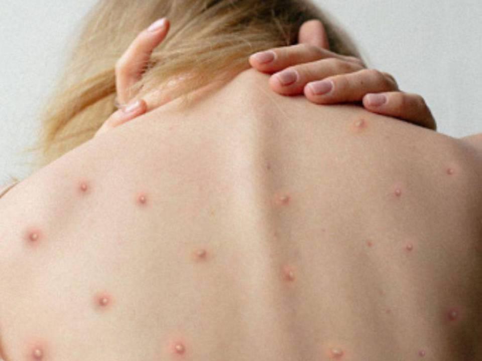 La letalidad de la viruela del mono es menor al 1%