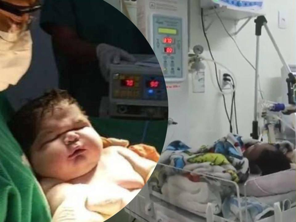 El pasado 18 de enero el nacimiento de Angerson Santos en Brasil sorprendió al mundo: pesó 16 libras y midió 59 centímetros, por lo que es considerado el bebé más pesado del mundo. Su madre fue sometida a cesárea en el hospital Padre Colombo. Esta es su historia.