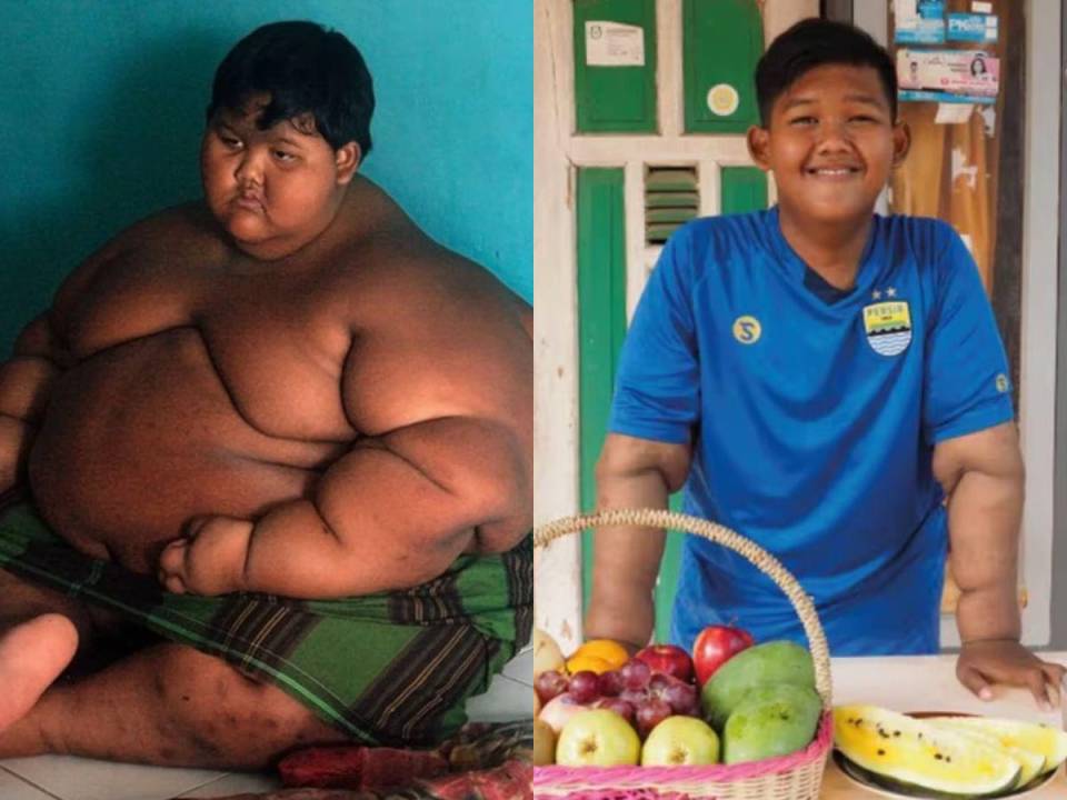 Arya Permana era considerado el niño más gordo del mundo. Cuando tenía 9 años pesaba 190 kilos (418 libras). A continuación te mostramos su impresionante cambio físico.